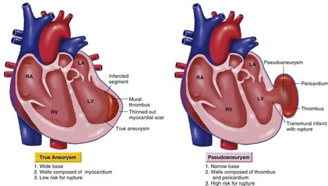 lv aneurysm|myocardial aneurysm.